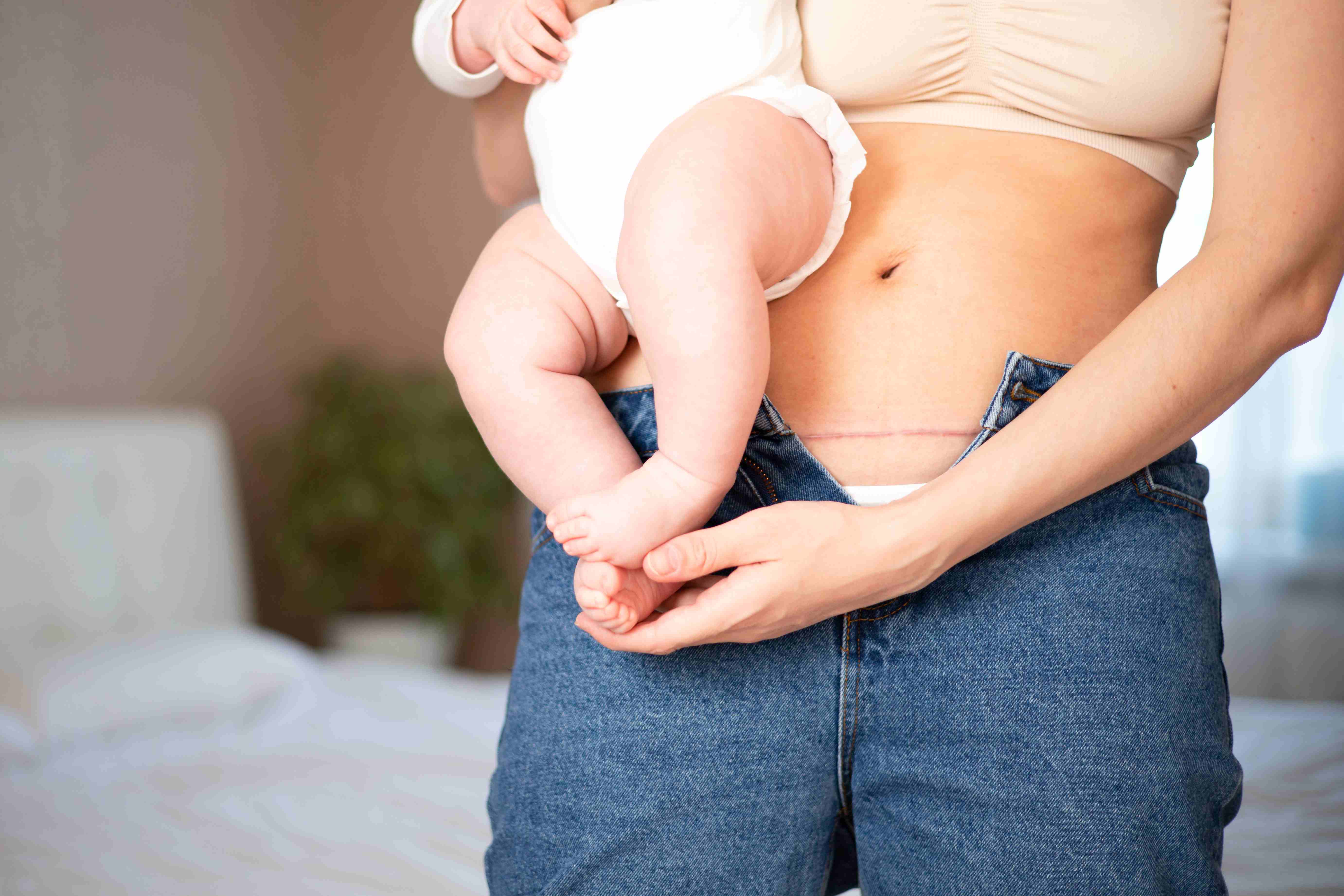 Postpartum mother showing C-section scar while holding baby, wearing unzipped jeans.